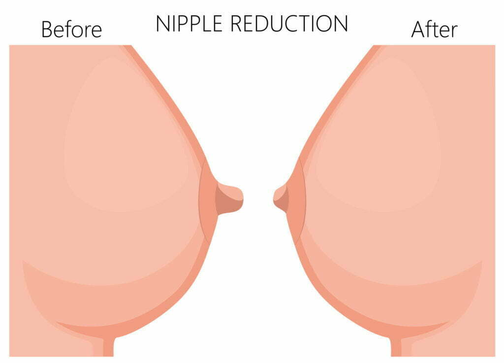 Nipple Reduction Surgery: A Solution for Large Protruding Nipples
