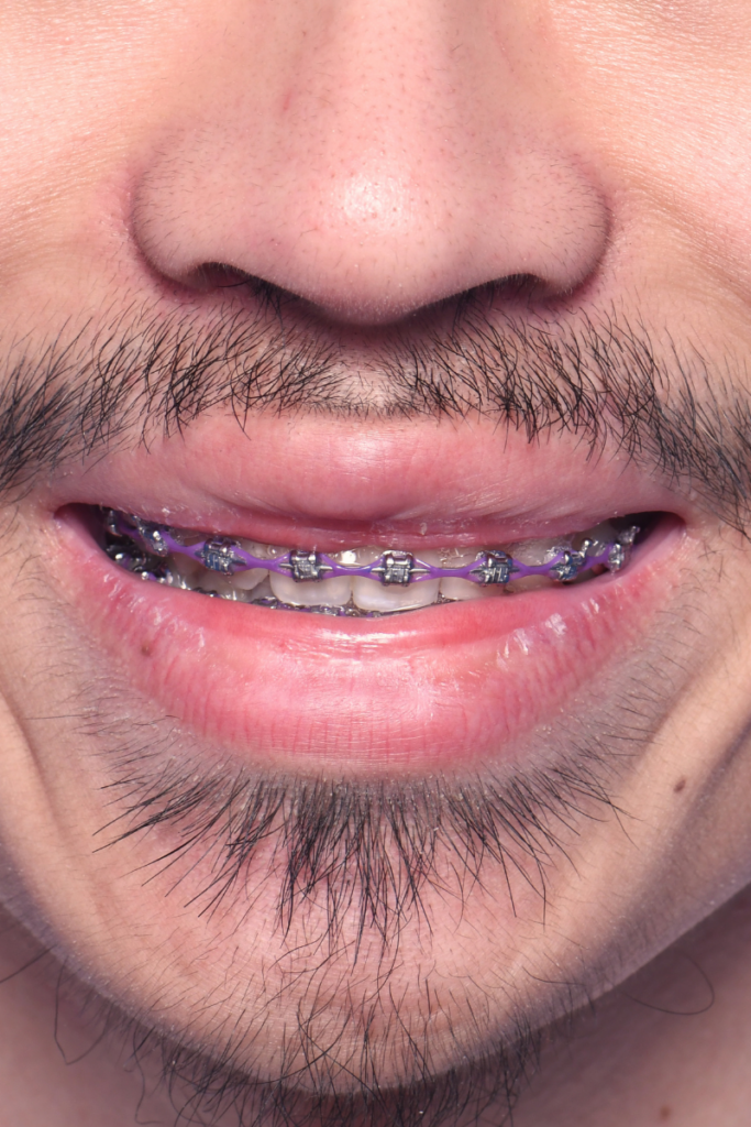 Before