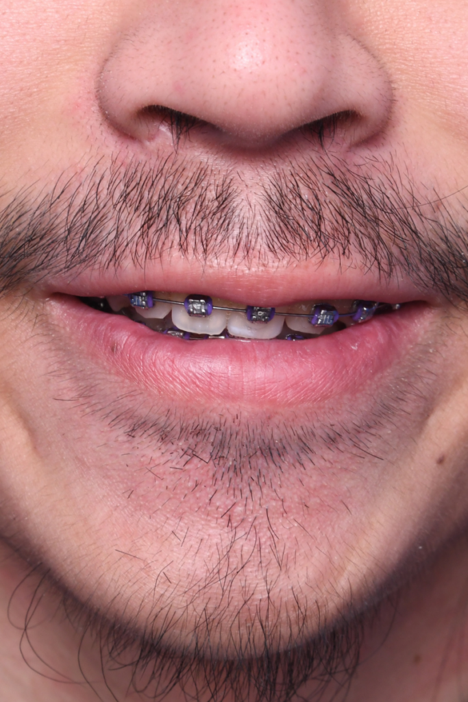 After