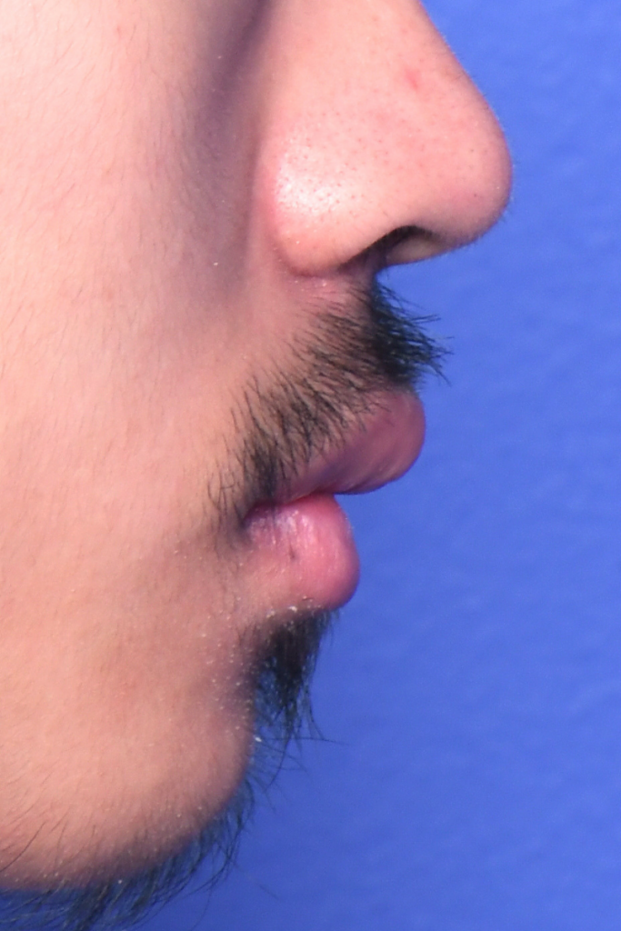 Before