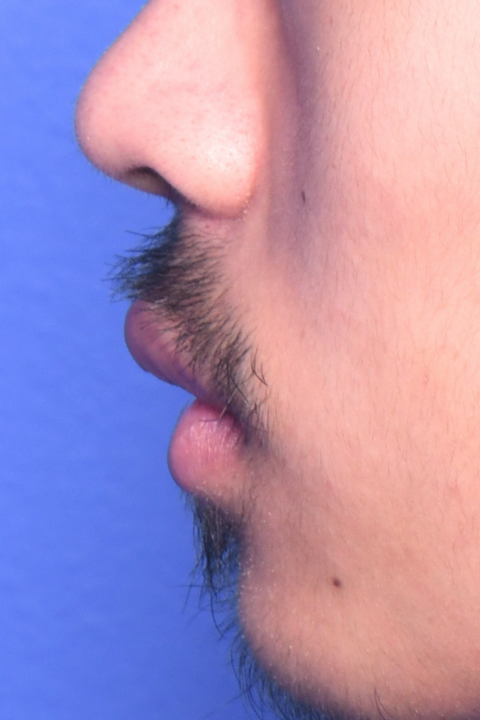 Before