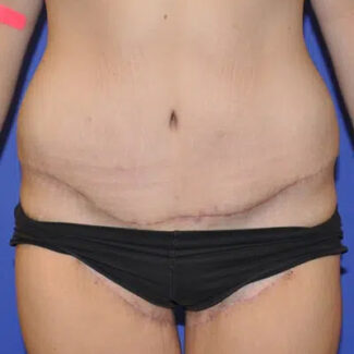 Prevenir una infección después de una abdominoplastia - Spanish Hourglass  Tummy Tuck