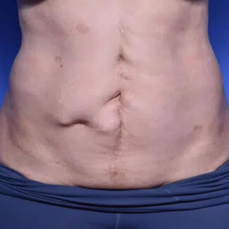 Buffalo Hump Liposuction - Houston Lipo Center